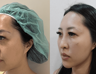 鼻雕容易失敗嗎?埋線隆鼻3種推薦線材